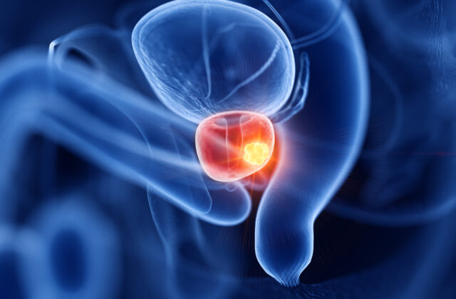 wizualizacja lokalizacji raka prostaty