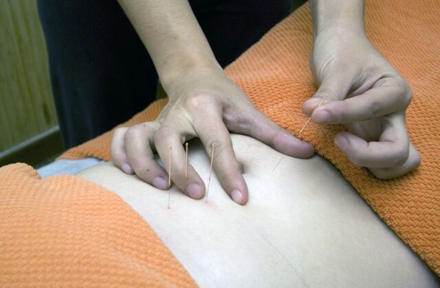 Akupunktura - ręce wbijające igłę w brzuch